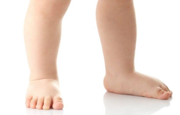 Childrens Podiatrist - Flat Feet