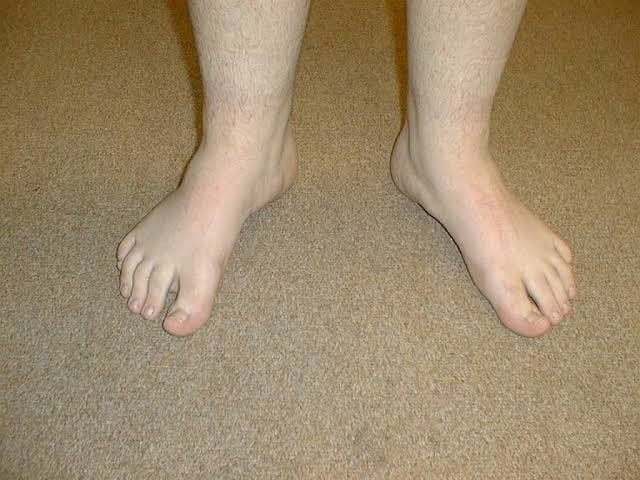 Treatment for Out Toeing in Children