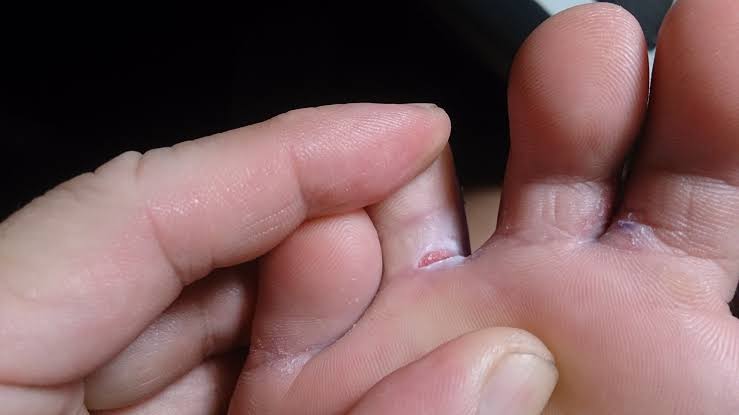 split skin under toe