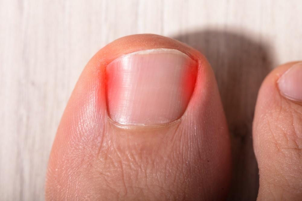 Ingrown Toenails Common FAQs Enable Podiatry